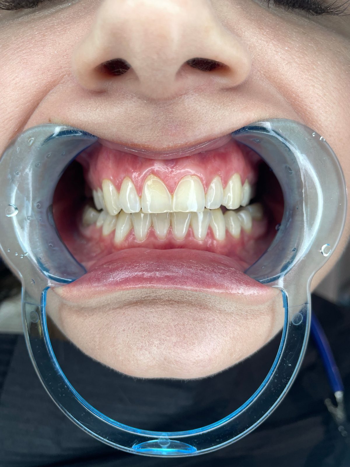 Boca aberta com afastador labial, preparada para o procedimento de clareamento
