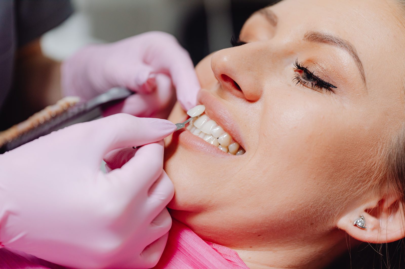 Dentista comparando um tom da escala de cores ao lado dos dentes do paciente