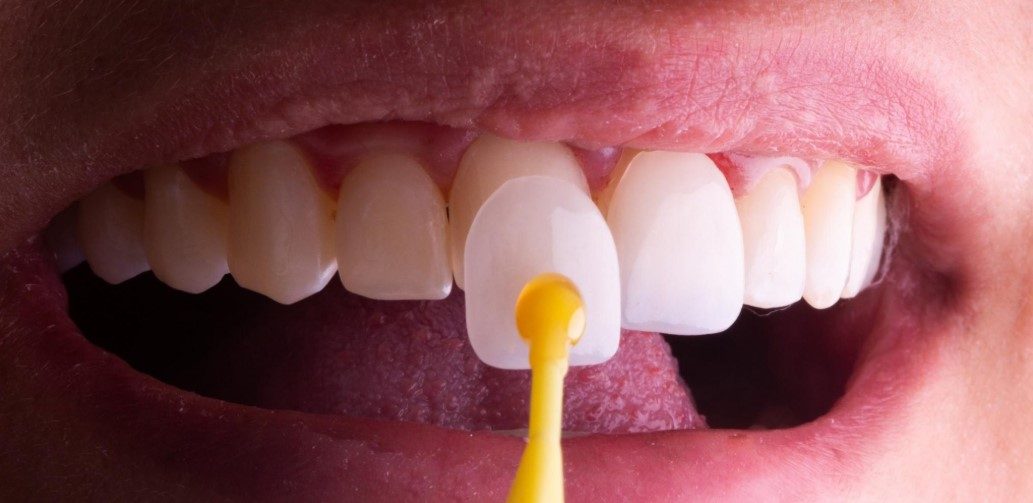 Lâmina de faceta dental sendo posicionada sobre um dente