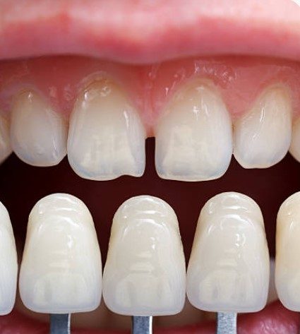 Comparação da cor de uma faceta dental ao lado dos dentes naturais